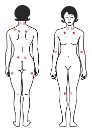 Points dpouloureux fibromyalgie