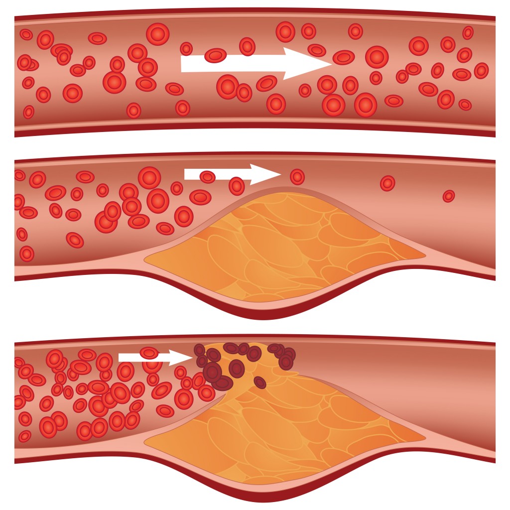 ATHEROME IMAGE