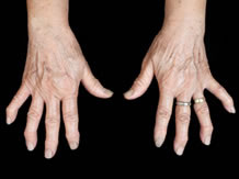 arthrose mains photo