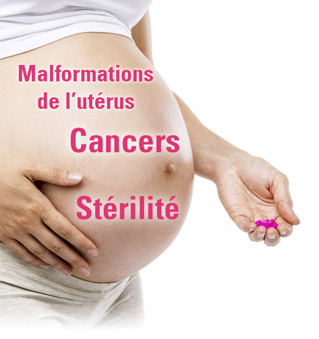 DISTILBÈNE FEMME ENCEINTE